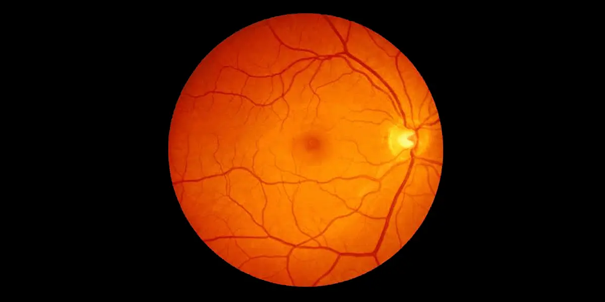 Digital eye strain and computer vision syndrome