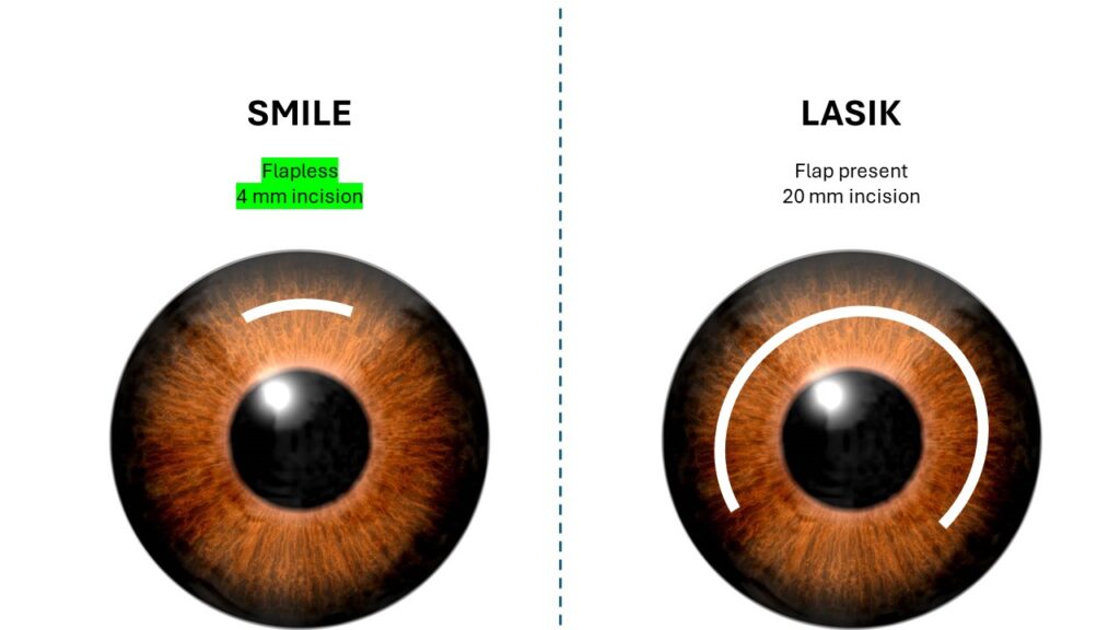 SMILE surgery vs LASIK surgery